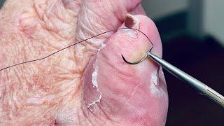 A SUTURE TO HEAL THE ULCER ?