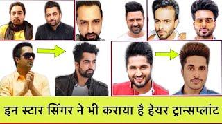 Case Study: Top Punjabi Singer Hair Transplant Surgery | Before After Hair transplant Result