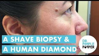 A Shave Biopsy and a Human Diamond!