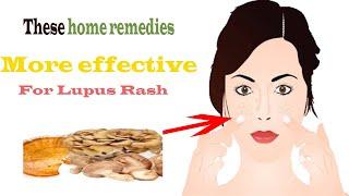 Top 10 Home Remedies For Lupus Rash|Healing Remedies