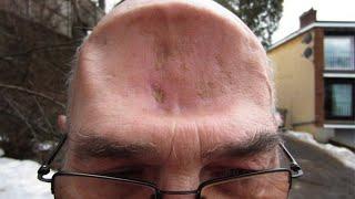 People Who Got a Bump On The Head And Became Geniuses