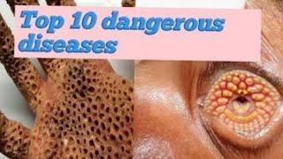 Top 10 Dangerous diseases  worse than covid 19 | Part-2 | lovefriendssathz | Tamil