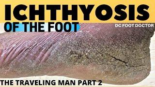 Ichthyosis of the Foot: Travelin' Man's Severe Skin Condition and Treatment