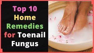 Top 10 Home Remedies for Toenail Fungus