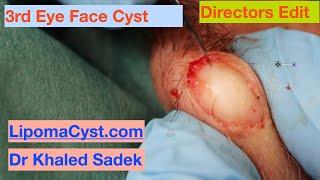 10 Year Eye Cyst. Dr Khaled Sadek. LipomaCyst.com