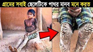 গ্রামের সবাই ছেলেটিকে দেখে খুব ভয় পেত ! পাথর মানব - ব্যতিক্রমধর্মী মানুষ !