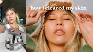 HOW TO CLEAR YOUR SKIN IN ONE MONTH | TOP 5 TIPS TO FLAWLESS SKIN