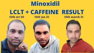 क्या आपके Minoxidil में LCLT और Caffeine है ? Minoxidil Treatment - Dr. Ashok Sinha