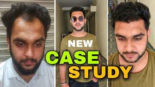 Hair Transplant Result After 6 Months | Case Study Of Best FUE Hair Transplant Result