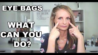 EYE BAGS WHAT CAN YOU DO? | WHAT HELPS EYE BAGS