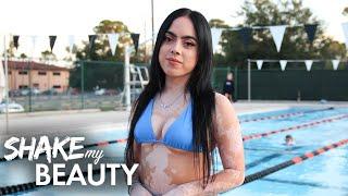 My Vitiligo Stopped Me Wearing Bikinis - Until Now | SHAKE MY BEAUTY