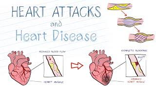 What is a Heart Attack?