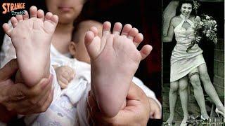 Top 10 People Born With Extra Body Parts | Strange Truth