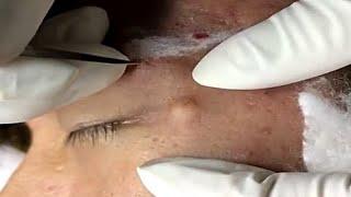 Nice Pop near eye removal