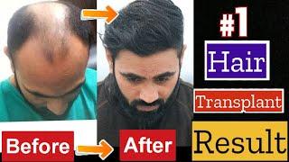 My Hair Transplant Journey from Bald to bold | Hair transplant in india