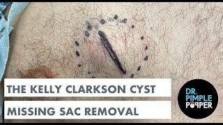 The Kelly Clarkson Epidermoid Cyst: WITH MISSING SAC WALL REMOVAL