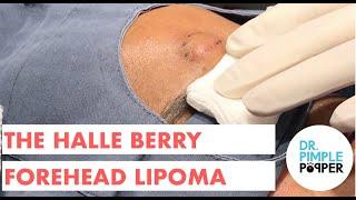 The Halle Berry Forehead Lipoma - OFFICE POP FLOPS