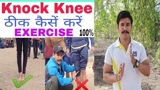 Knock Knee Problem How to Remove and Top 5 Exercises in Hindi||Knock knee kese thik karen