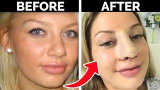 Was My £10,000 Nose Job Really Worth Doing?