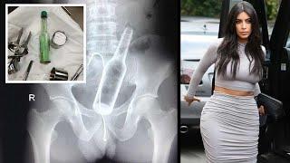 Top 10 Strangest Objects Extracted From Human Body (2020)!!