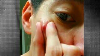 Top 10 Amateur Cysts, Pimples and Acne Pops!  Comedone Express