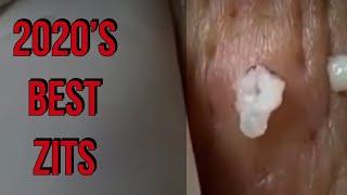 Top Ten Whitehead and Blackhead Pimple Pops 2020