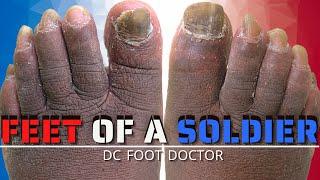 Feet of a Soldier: Trimming Fungal Toenails In A Newly Diagnosed Diabetic-THANK YOU FOR YOUR SERVICE