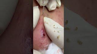 blackhead removal on face satisfying #44 | Top Best Pimple Popping Videos 2019