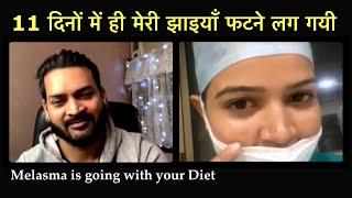 Just in 11 days my Melasma is going with your diet. 11 दिनों में ही मेरी झाइयाँ फटने लग गयी.