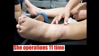 Special case, She operations 11 time  - Chris Leong | BONE SPECIALIST | BONE CRACKING 马来西亚吉隆坡跌打