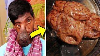 This Boy's Brain Starts Leaking Out Of His Skull, Forcing Doctors To Reveal A Shocking Secret