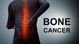 Bone Cancer – Top Bone Cancer Symptoms and Regular Causes of this Problem