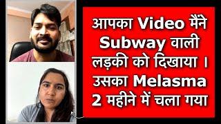 2 महीने में झाइयाँ ख़त्म - Melasma gone in 2 months. Story of a Subway Girl in Toronto, Canada.