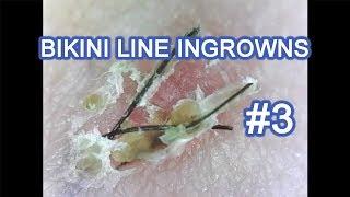 Satisfying Bikini Line Ingrowns #3 (READ DESCRIPTION)