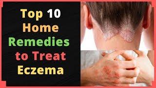 Top 10 Home Remedies to Treat Eczema