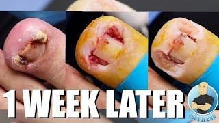 HEALING PROCESS OF AN INFECTED INGROWN TOENAIL