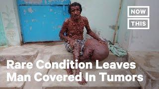 Rare Condition Leaves Man Covered In Small Tumors & 56-lb Mass on Leg | NowThis