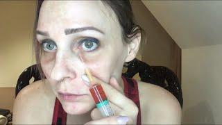 DIY PRP TREATMENT FOR DARK CIRCLES AND NASOLABIAL FOLDS!