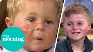 Boy With 'Butterfly' Skin Returns 10 Years Later To Show Eamonn His Improvements | This Morning