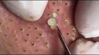 TOP 10 Acne Treatment Whiteheads Blackhead Extraction # 2