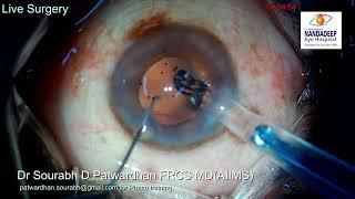 Live surgery from Nandadeep Eye Hospital Dr Sourabh Patwardhan