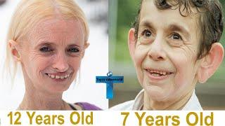 Top 10 Unusual Kids Who Growing Too Fast From Their Age Born Different