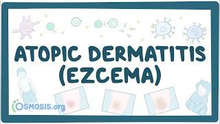 Atopic dermatitis (eczema) - causes, symptoms, diagnosis, treatment, pathology