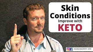 9 Skin Conditions Improved with KETO - 2020 (Acne, Eczema, Psoriasis...)