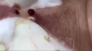 BLACKHEADS REMOVAL #15