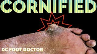 Cornified: Extremely Thick and Hard Callus Removal