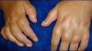 Why Fingers Swell ,Causes,Symptoms Etc|Bright Here