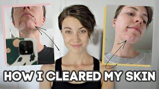 How I Cleared My HORMONAL ACNE Naturally (10+ years of acne...)