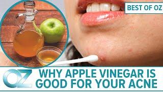 How Apple Cider Vinegar Is Good For Your Skin and Acne - BEST OF OZ COLLECTION