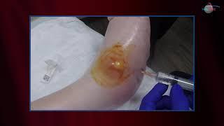 WCW: Draining an Abscess on Top of the Foot